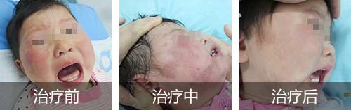 海口市有治疗太田痣的医院吗