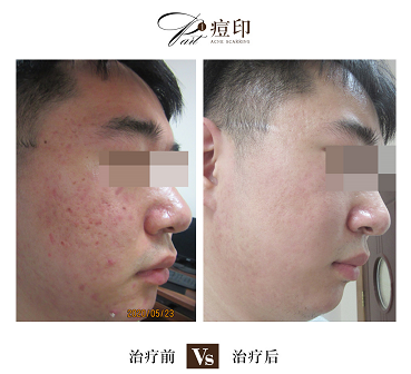 海口治疗痘印的医院哪家好